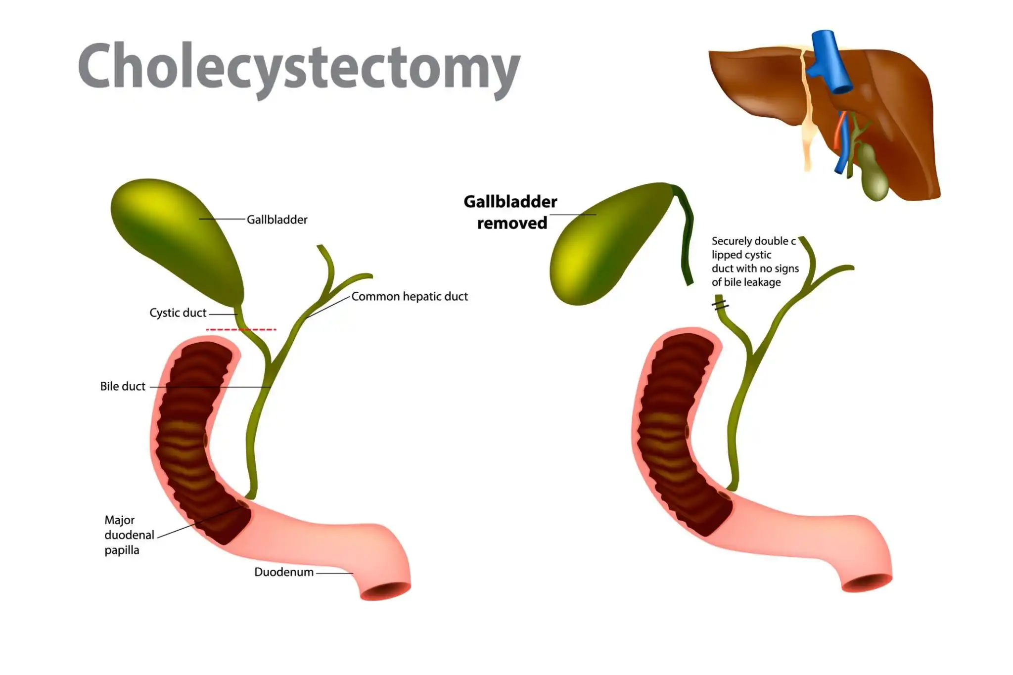 Surgical Solutions for Gallstones: Cholecystectomy in Bangalore