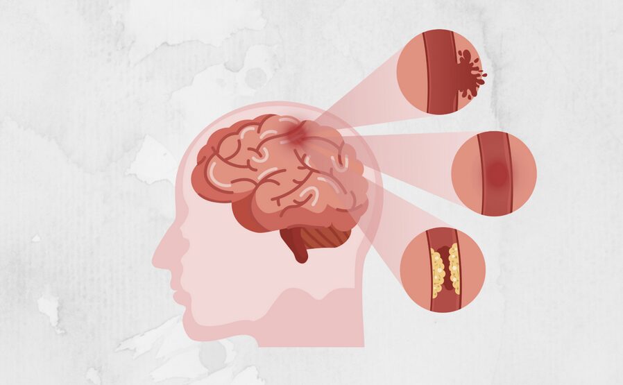 Stroke Symptoms Are Not Always Dramatic. Here’s What People Miss